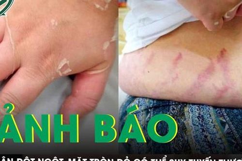 Tăng cân đột ngột, mặt tròn đỏ cảnh báo suy tuyến thượng thận