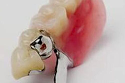 Đồng Nai: Gắp thành công 3 răng giả sau 6 ngày mắc kẹt trong thực quản nữ bệnh nhân