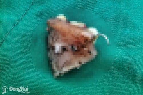 Lấy răng giả móc vào thực quản cho nữ bệnh nhân ở Định Quán