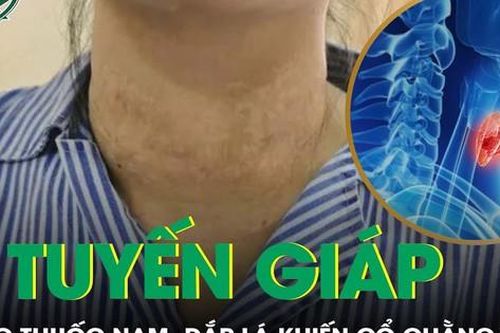 Cổ chằng chịt sẹo, sức khỏe suy kiệt sau khi đắp lá chữa u tuyến giáp