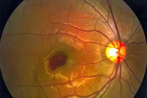 Nam thanh niên suýt mù vì đèn laser chiếu thẳng vào mắt 2 giây