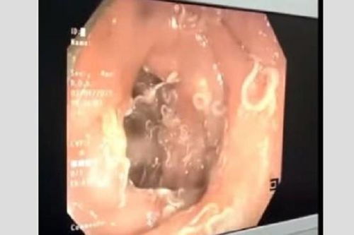 Hàng trăm con giun 'trú ngụ' trong đường tiêu hóa người phụ nữ
