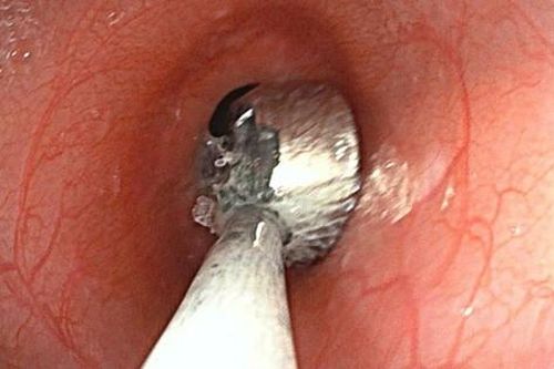Bé gái 19 tháng tuổi nuốt phải cục pin trong lúc chơi