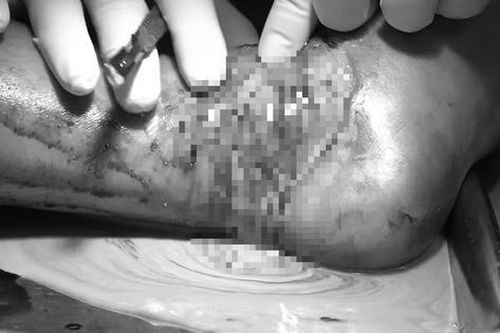 Bé trai 12 tuổi nhiễm trùng nặng do đắp lá chữa bong gân