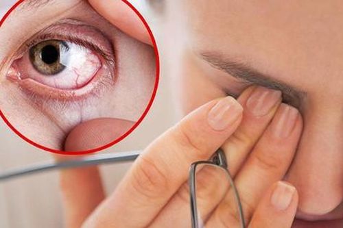 Mắt nhức mỏi là biểu hiện của bệnh gì?
