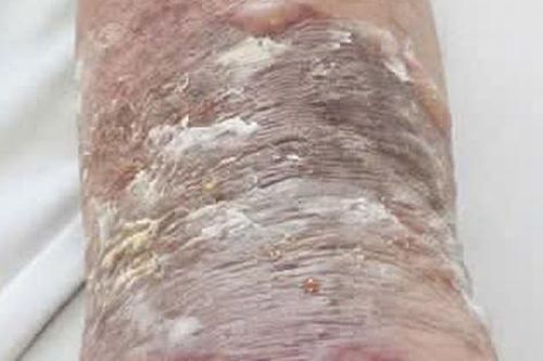 Bôi dầu nóng chữa gãy xương, người đàn ông bị nhiễm trùng da