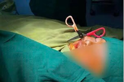 Phẫu thuật lấy bỏ kéo đâm vào mặt bé gái 6 tuổi
