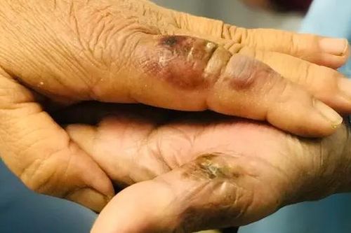 Hai vợ chồng phải nhập viện sau khi bị chuột cắn