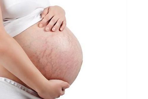 Làm gì để làm mờ các vết rạn da sau sinh?