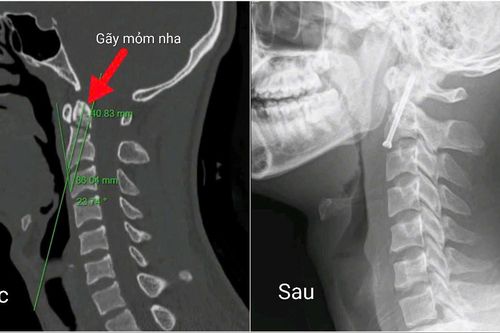 Phẫu thuật nội soi thành công ca gãy cột sống cổ phức tạp