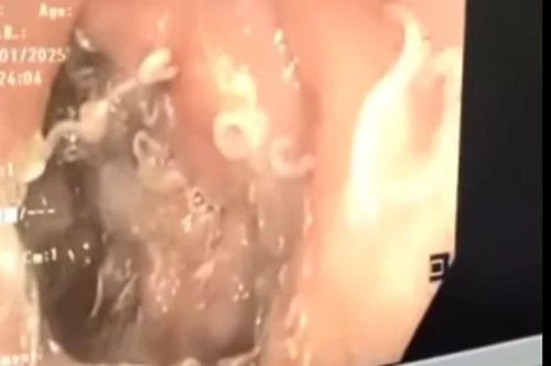 Hàng trăm con giun trú ngụ trong thành tá tràng người bệnh