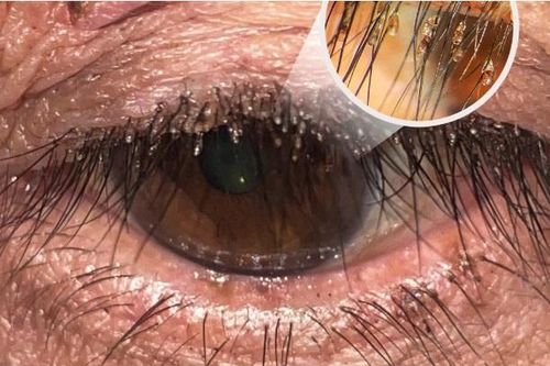 Phát hiện rận mu làm tổ chi chít trên mắt người đàn ông ở Ninh Bình
