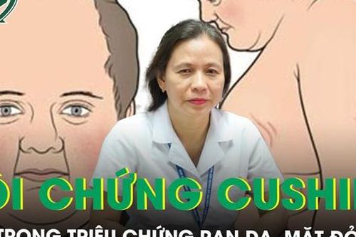 Rạn da, mặt đỏ tròn cẩn trọng với hội chứng Cushing