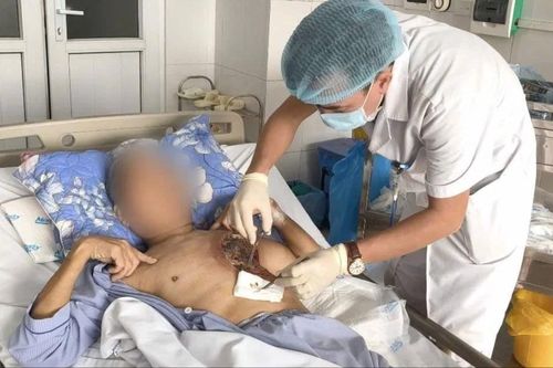 Nhiễm nấm hiếm gặp, một người quản trang bị hoại tử vùng ngực