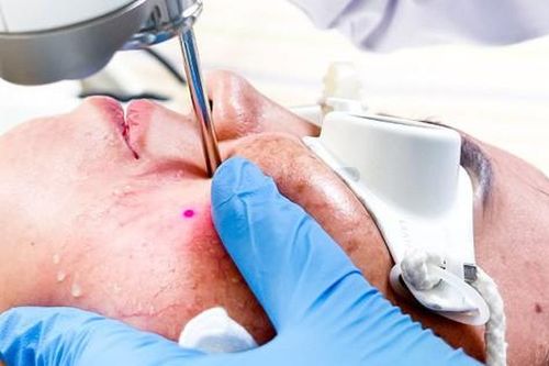 Dùng kem trắng da cấp tốc đón Tết, người phụ nữ 32 tuổi ở Bình Dương nhập viện gấp