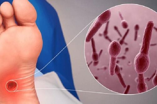 Ai cần tiêm uốn ván chủ động?