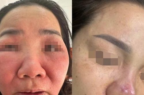 Môi cá trê, mặt biến dạng sau liệu trình giá rẻ, đẹp nhanh đón Tết