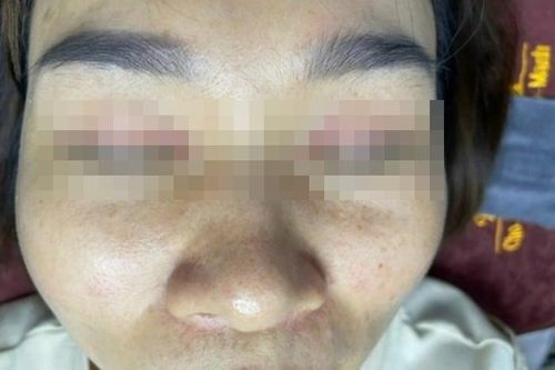 Hỏng da sau khi bôi loại kem được spa cam kết 'hết mụn sau 3 ngày'