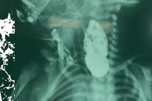 Bé sơ sinh 4 ngày tuổi bị teo thực quản may mắn được cứu sống