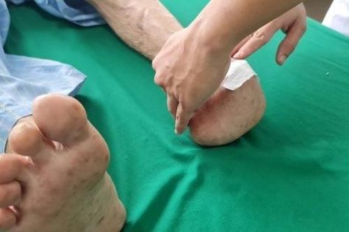Phòng tránh biến chứng loét bàn chân, người bệnh đái tháo đường cần chăm sóc bàn chân như thế nào?