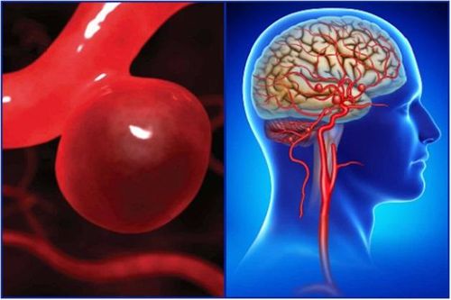 Người đàn ông 30 tuổi bất ngờ vỡ mạch mãu não, đột quỵ vì tắm đêm theo cách này