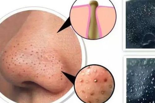 Cách trị mụn đầu đen trên mặt hiệu quả