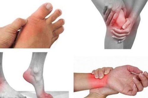 Điều trị hội chứng Felty bằng cách nào?