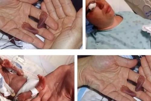 Bé sinh non nhẹ nhất thế giới, chỉ nặng 280g, được ví như 'hạt đậu' từng gây chấn động giờ ra sao?