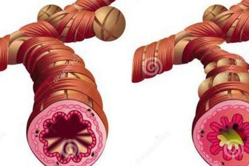 Dấu hiệu cảnh báo cơn hen phế quản cấp tính và cơn hen nguy kịch