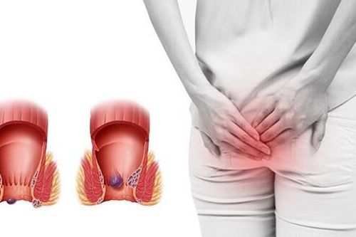 Bệnh trĩ chữa bằng phương pháp nào hiệu quả? cách chăm sóc sau phẫu thuật