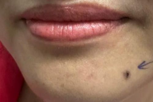 Tưởng 'nốt ruồi son', người phụ nữ đi khám phát hiện sự thật đau lòng