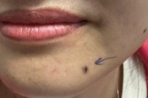 Phát hiện ung thư da từ chấm đen nhỏ như hạt đỗ