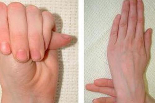 5 câu hỏi thường gặp cho người mắc hội chứng Marfan