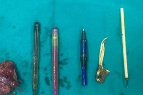 Bác sĩ ngạc nhiên khi lấy ra nhiều thứ kỳ dị trong bụng bệnh nhân