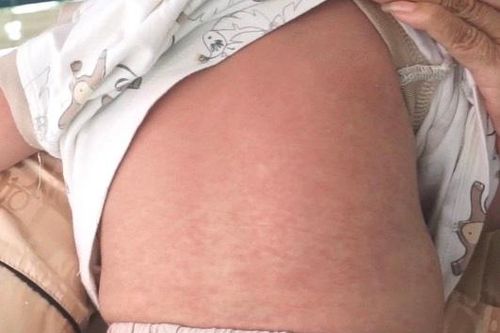 Phát hiện ổ dịch sởi, Hải Dương tăng cường tiêm vaccine