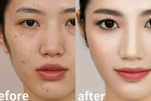 Cách trang điểm cho da mụn không bị kích ứng