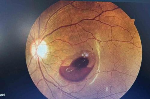 Bị tia laser ở quán bar chiếu vào mắt, cô gái 18 tuổi đối diện nguy cơ mất thị lực