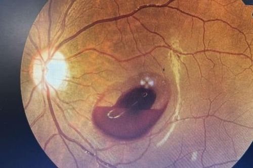 Đi chơi quán bar, cô gái trẻ mất thị lực do bị tia laser chiếu vào mắt