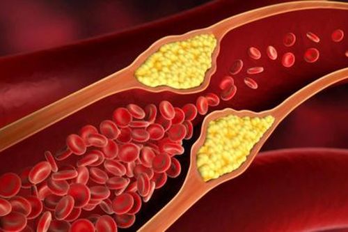 Khả năng điều trị dứt điểm mỡ trong máu