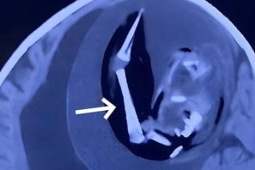 Đầu bé gái to bất thường, bác sĩ sốc nặng khi phát hiện thứ bên trong