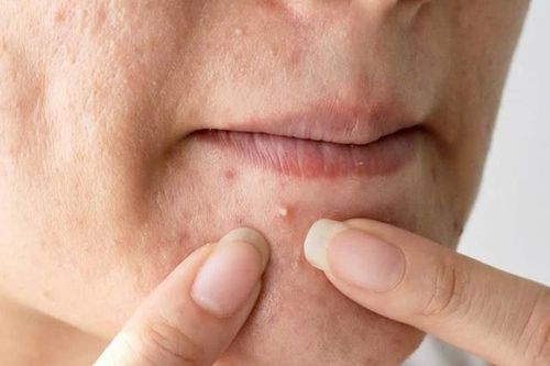Cách chăm sóc và điều trị mụn trứng cá ở tuổi dậy thì