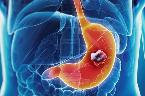 6 nhóm người dễ thành 'mục tiêu' của ung thư dạ dày