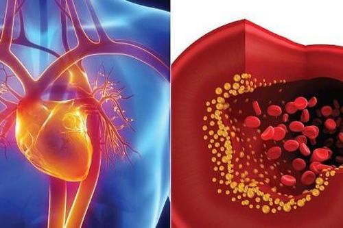 Rối loạn mỡ máu ở người cao tuổi nên ăn gì?