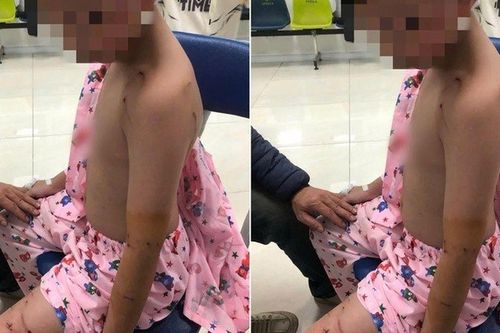 Thương tâm: Đi chúc Tết, bé trai bị chó tấn công phải khâu nhiều mũi