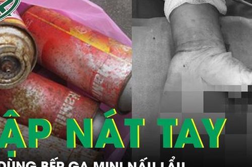 Nam đầu bếp bỏng nặng, dập nát tay khi dùng bếp ga mini nấu lẩu