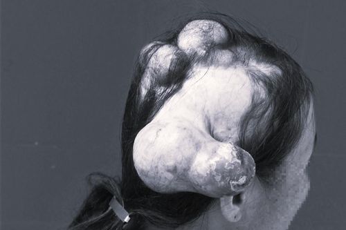 Bệnh ung thư khiến người phụ nữ 'mọc sừng' chi chít trên đầu