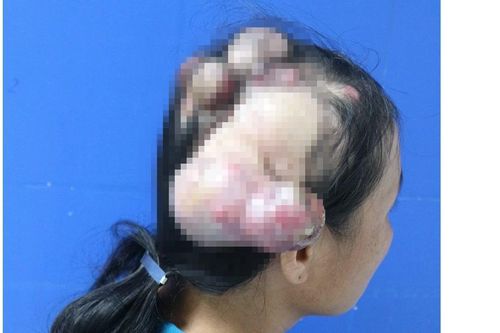 Phẫu thuật thành công cho bệnh nhân bị 'mọc sừng' do ung thư da đầu