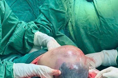 Hy hữu bé trai chào đời vẫn nằm trong bọc ối ở Nghệ An