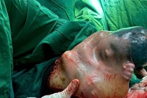 Bé trai 'đẻ bọc điều', 80.000 ca mới có một