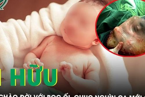 Hi hữu em bé chào đời với bọc ối, chục nghìn ca mới có một
